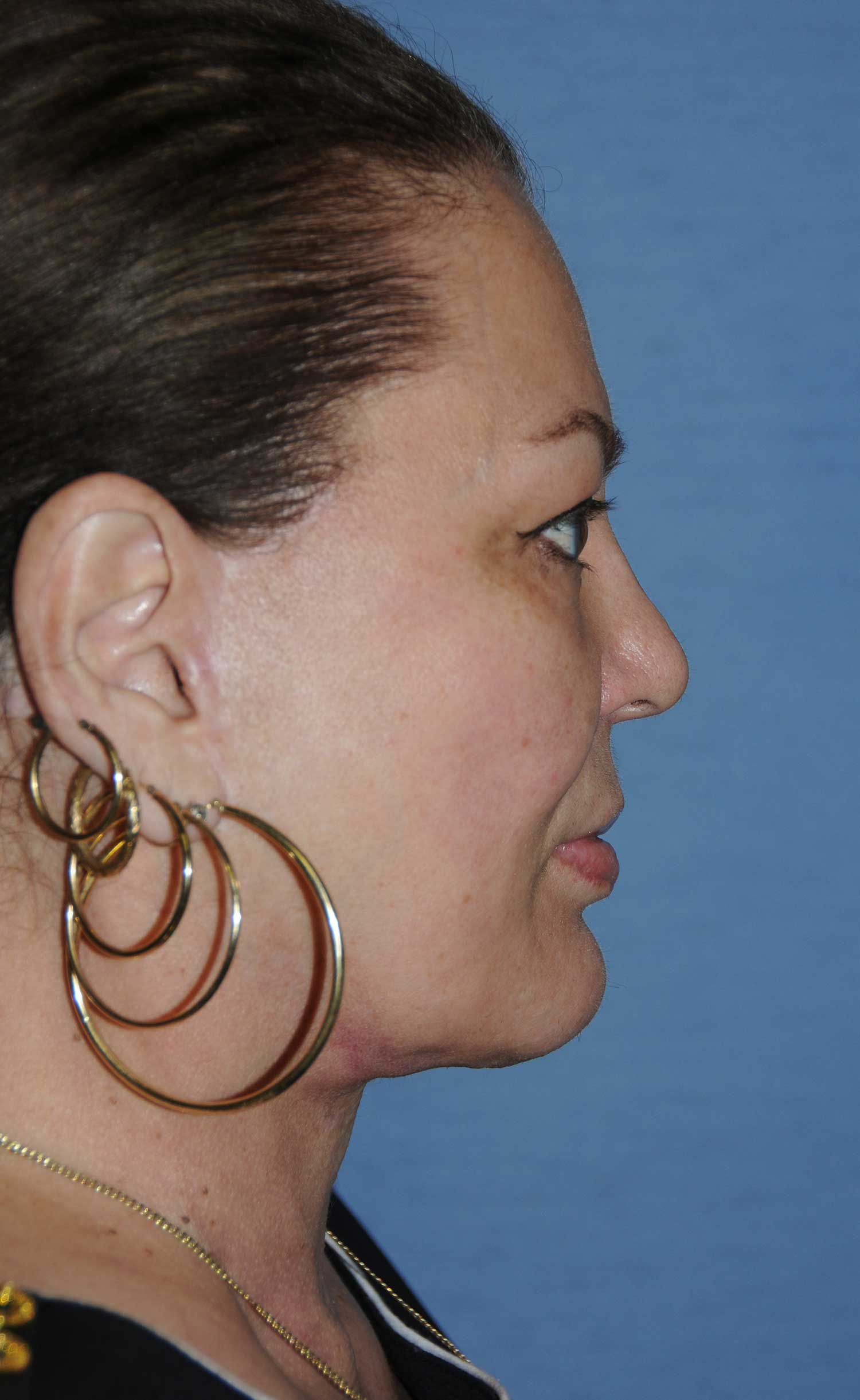 Neck Lift Before & After Photo