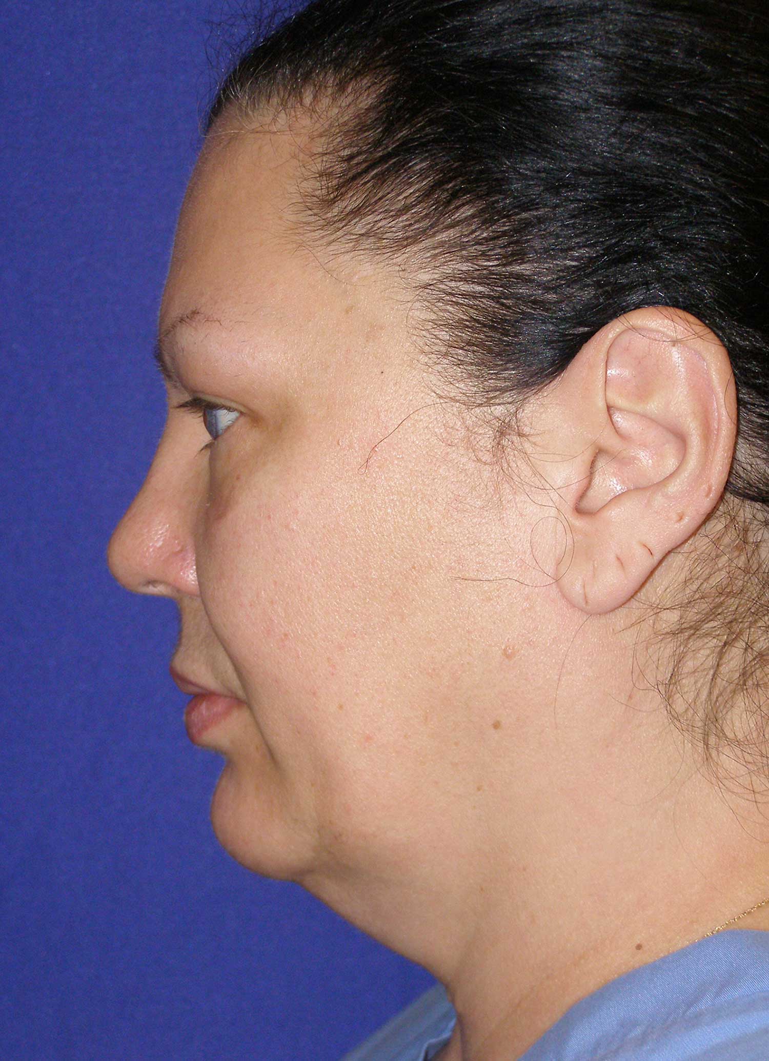 Neck Lift Before & After Photo