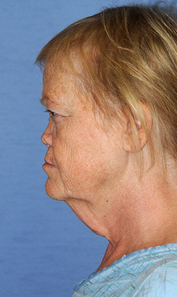 Neck Lift Before & After Photo