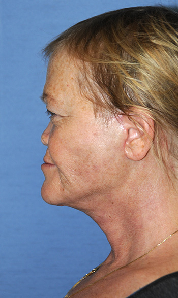 Neck Lift Before & After Photo