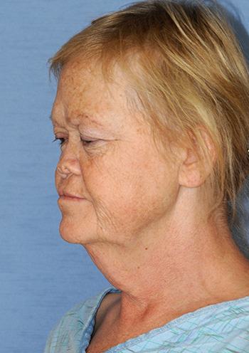 Neck Lift Before & After Photo