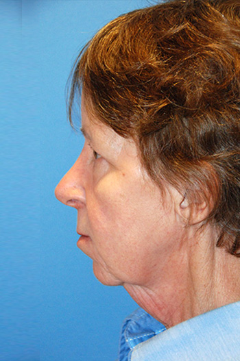 Neck Lift Before & After Photo