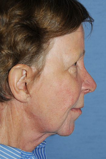 Neck Lift Before & After Photo