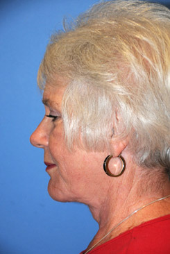 Neck Lift Before & After Photo