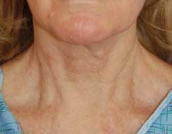 Neck Lift Before & After Photo