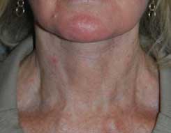 Neck Lift Before & After Photo