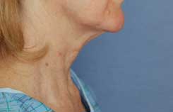 Neck Lift Before & After Photo