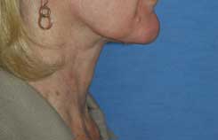 Neck Lift Before & After Photo