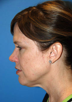 Neck Lift Before & After Photo