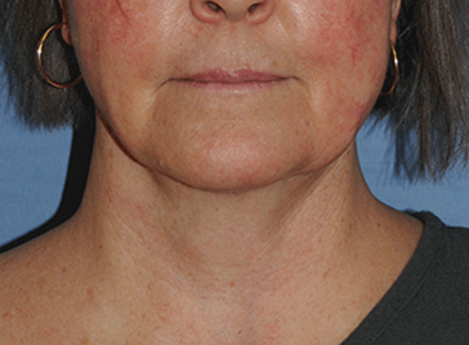 Neck Lift Before & After Photo