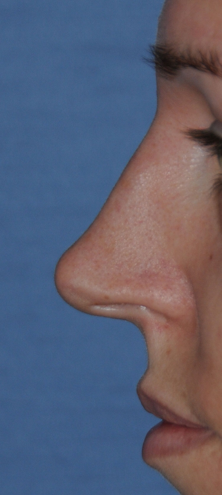 Rhinoplasty Before & After Photo