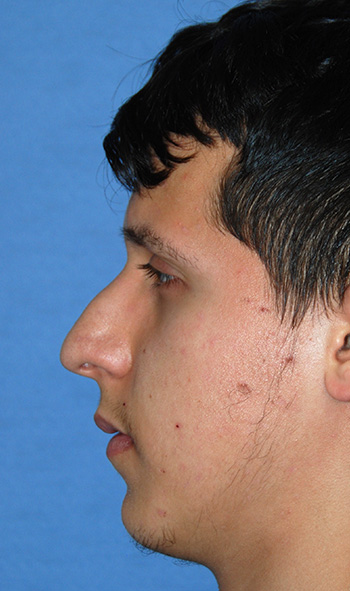 Rhinoplasty Before & After Photo