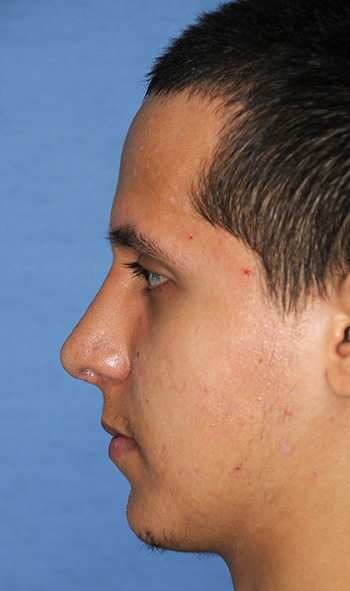 Rhinoplasty Before & After Photo