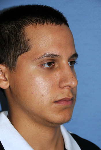 Rhinoplasty Before & After Photo