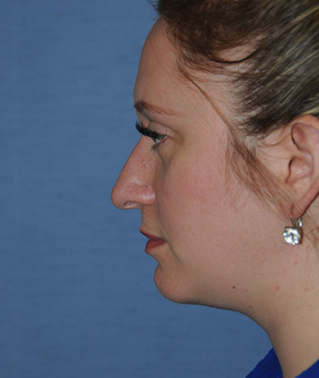 Rhinoplasty Before & After Photo