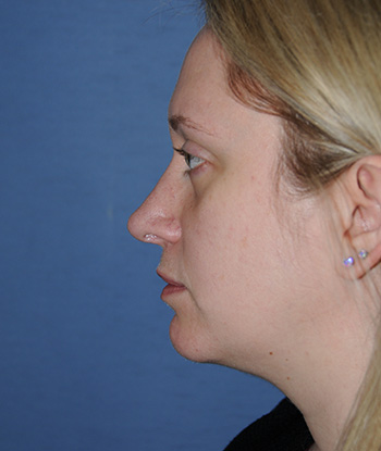 Rhinoplasty Before & After Photo