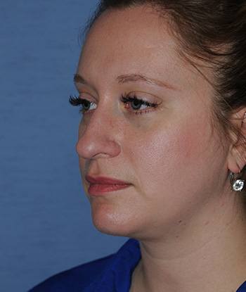 Rhinoplasty Before & After Photo