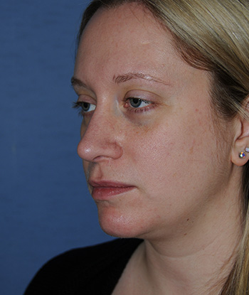 Rhinoplasty Before & After Photo