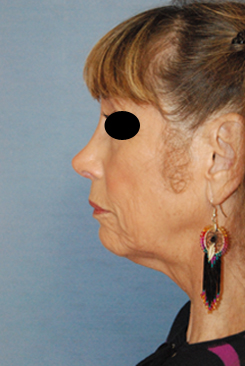 Rhinoplasty Before & After Photo