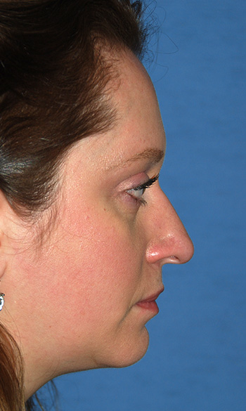 Rhinoplasty Before & After Photo