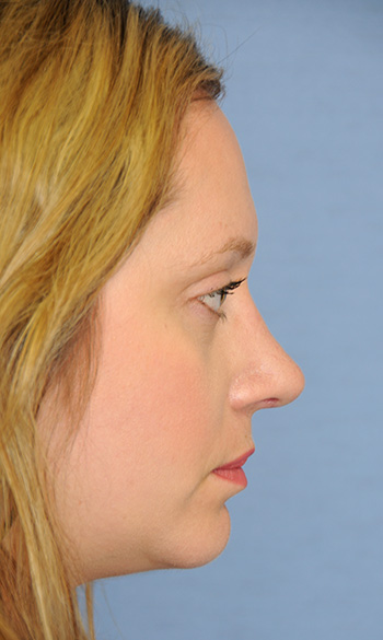 Rhinoplasty Before & After Photo