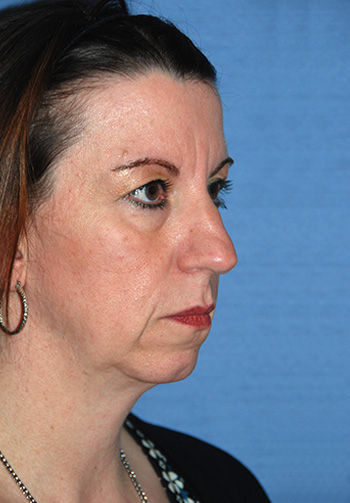 Rhinoplasty Before & After Photo