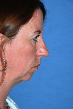 Rhinoplasty Before & After Photo