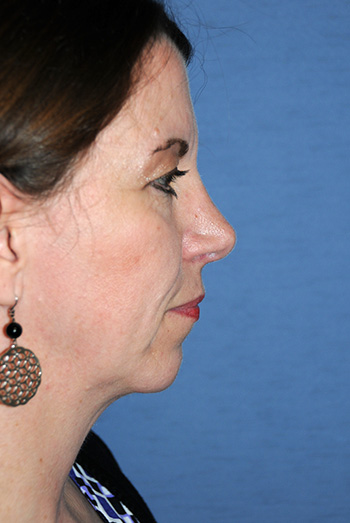 Rhinoplasty Before & After Photo