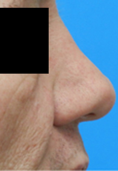 Rhinoplasty Before & After Photo