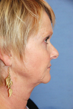 Rhinoplasty Before & After Photo