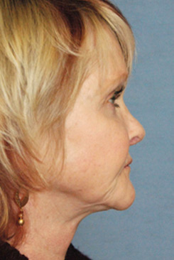 Rhinoplasty Before & After Photo