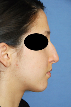 Rhinoplasty Before & After Photo