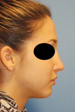 Rhinoplasty Before & After Photo