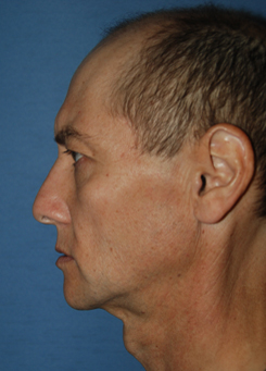 Rhinoplasty Before & After Photo