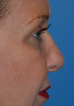 Rhinoplasty Before & After Photo