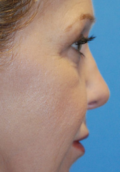 Rhinoplasty Before & After Photo