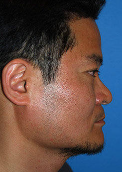 Rhinoplasty Before & After Photo