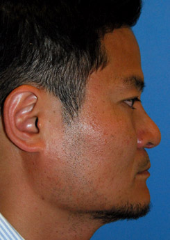 Rhinoplasty Before & After Photo