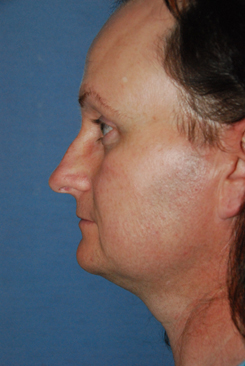 Rhinoplasty Before & After Photo