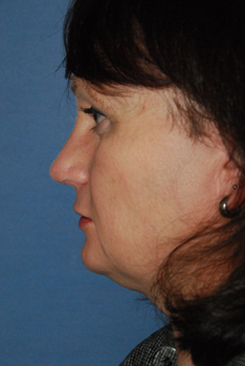 Rhinoplasty Before & After Photo