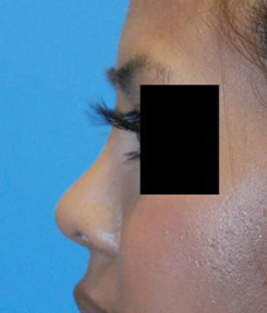 Rhinoplasty Before & After Photo