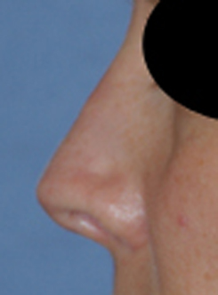 Rhinoplasty Before & After Photo