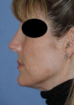 Rhinoplasty Before & After Photo