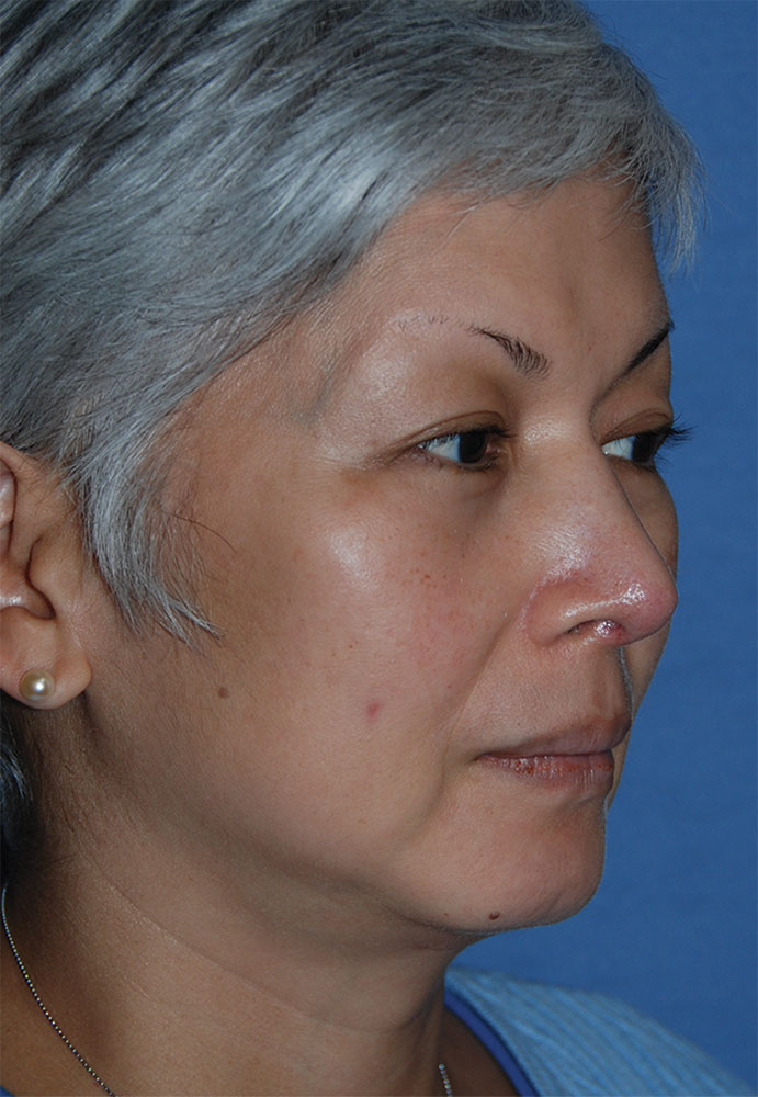 Rhinoplasty Before & After Photo