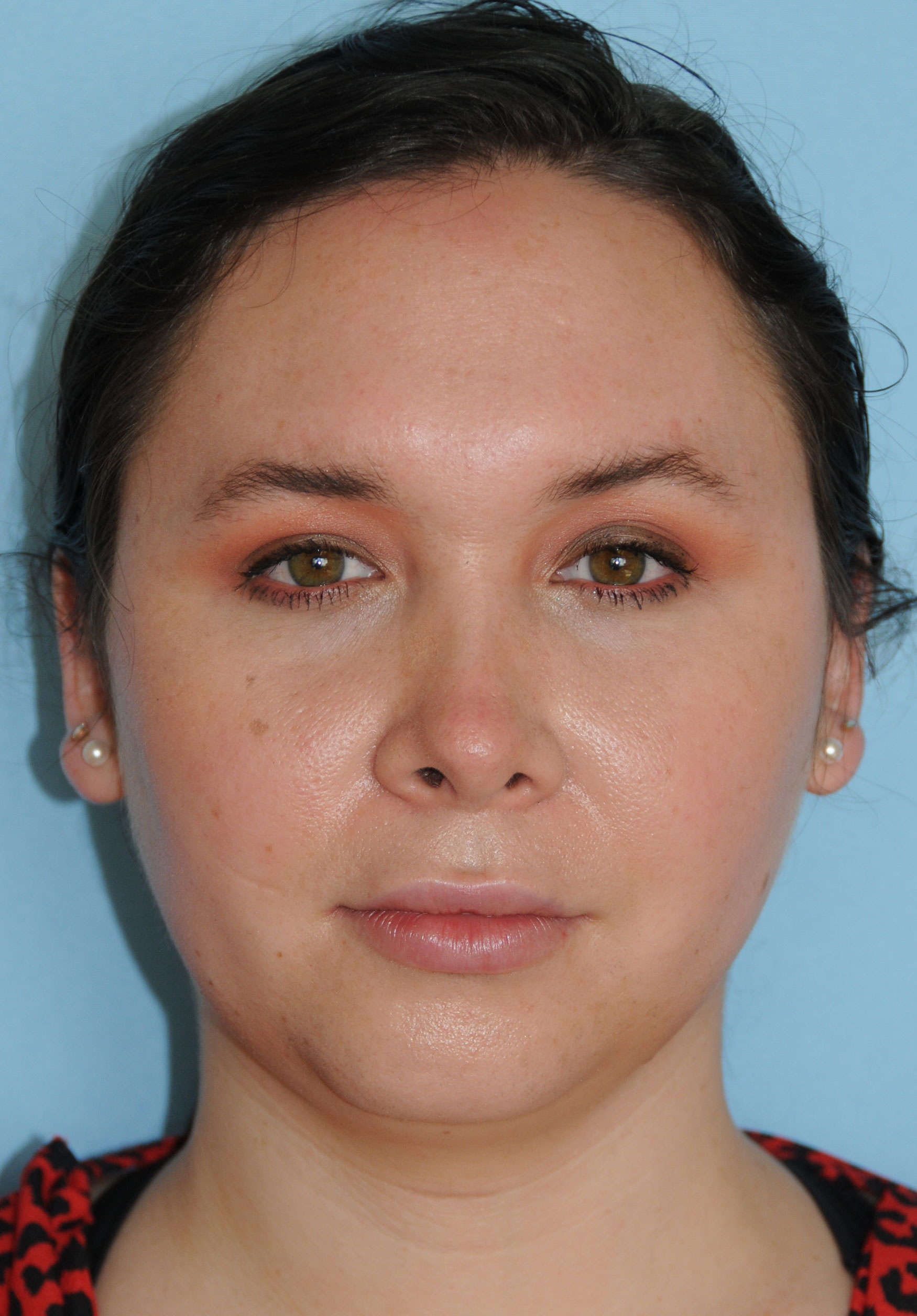 Rhinoplasty Before & After Photo