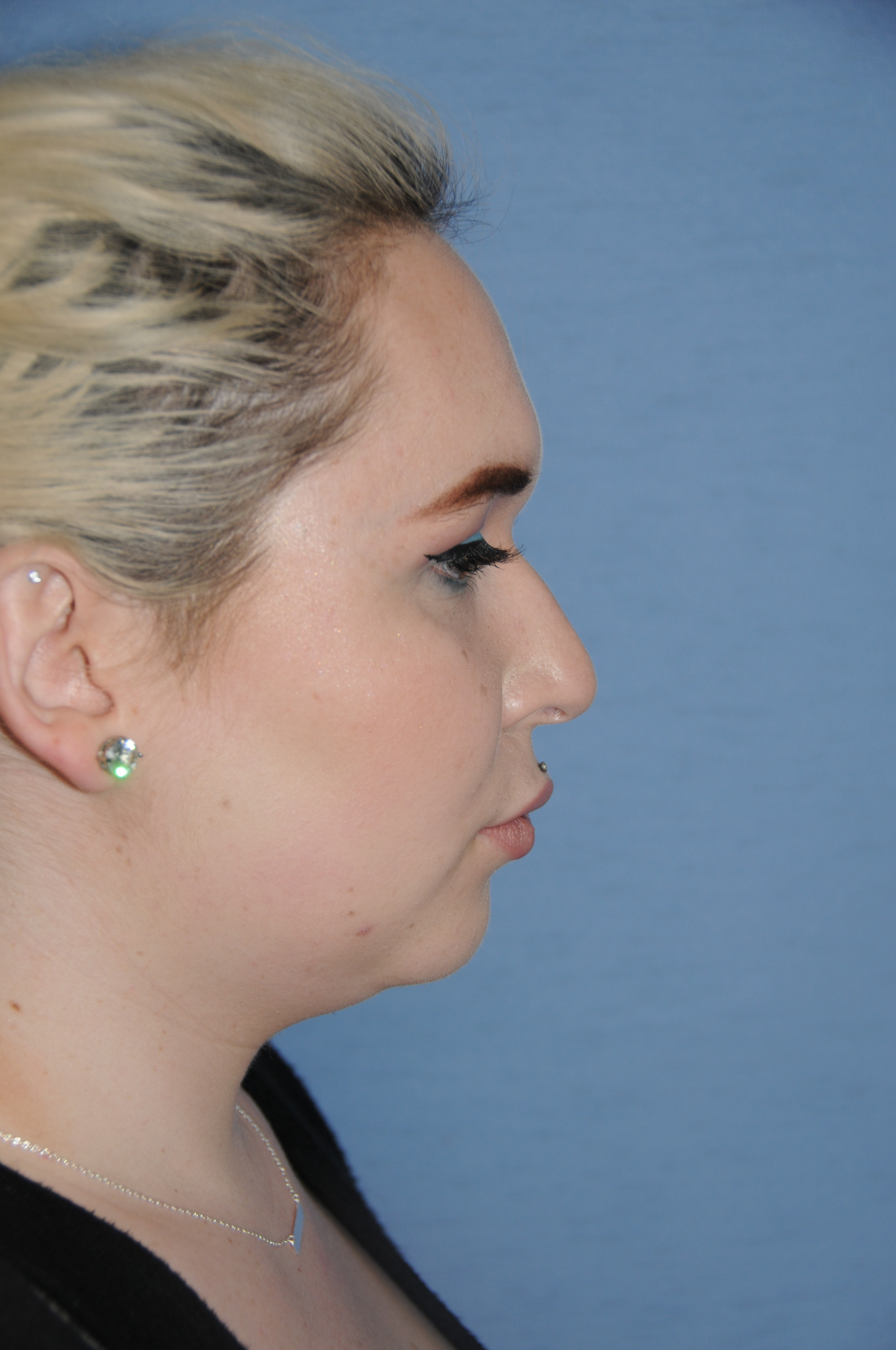 Rhinoplasty Before & After Photo