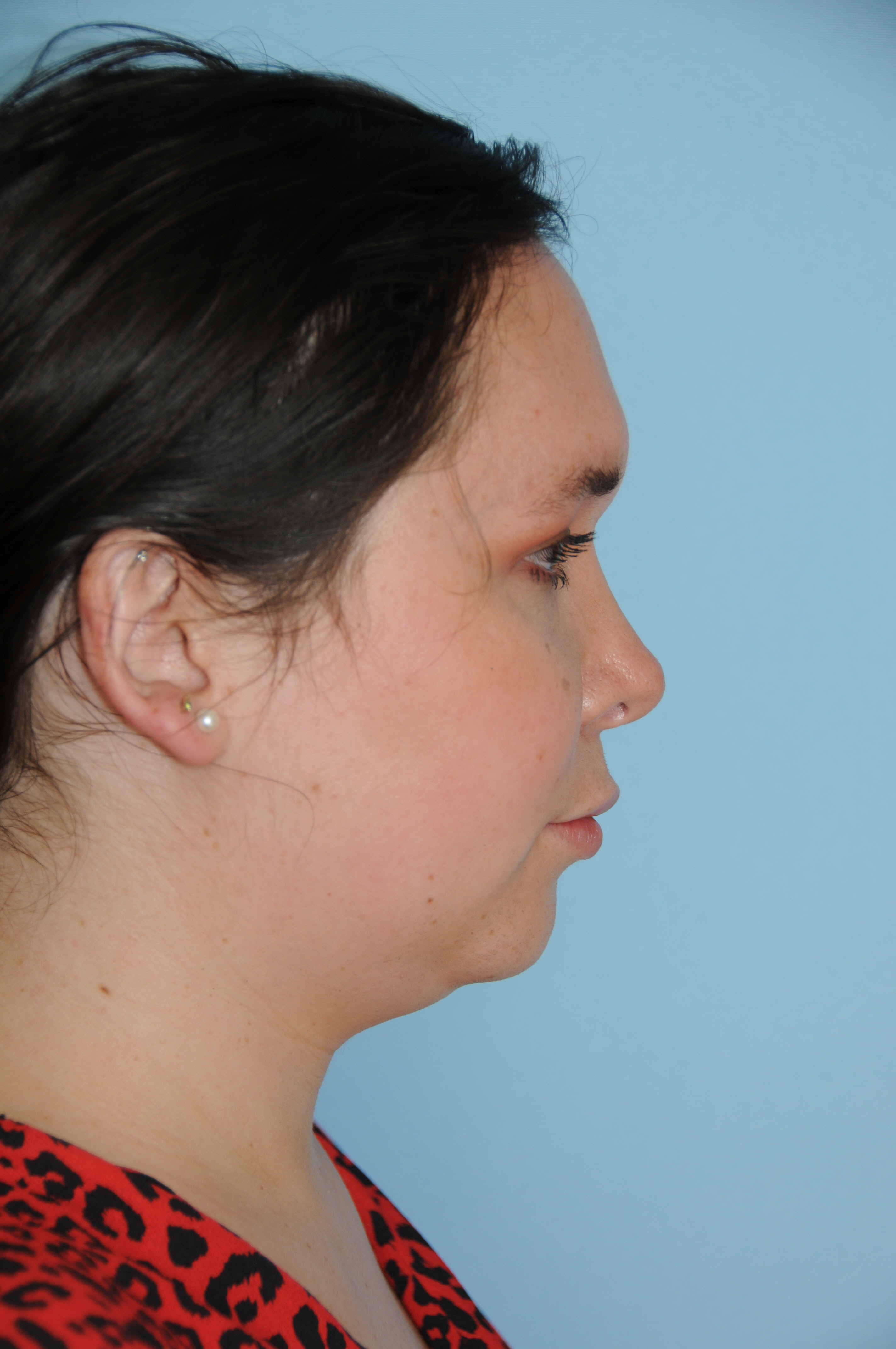 Rhinoplasty Before & After Photo