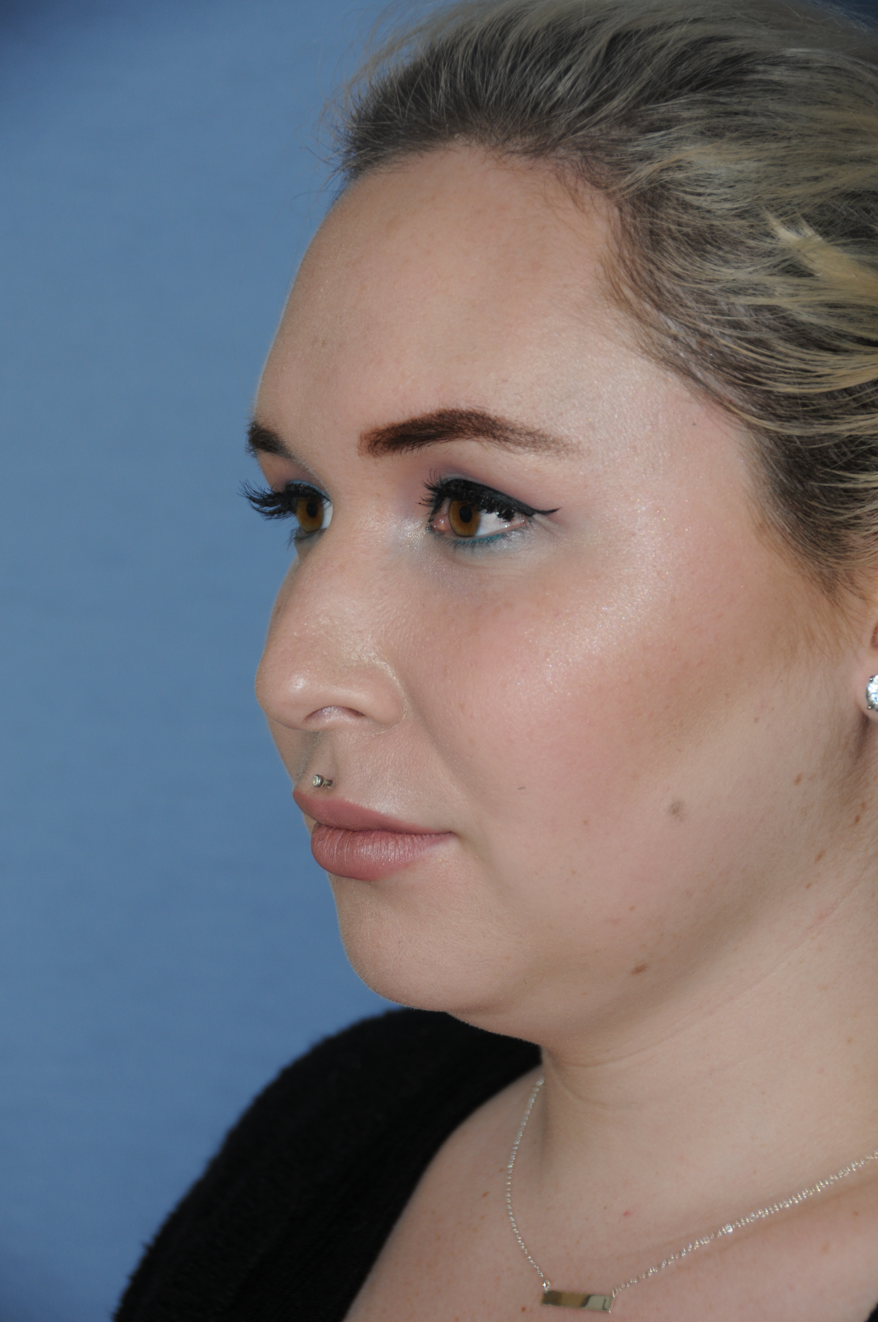 Rhinoplasty Before & After Photo