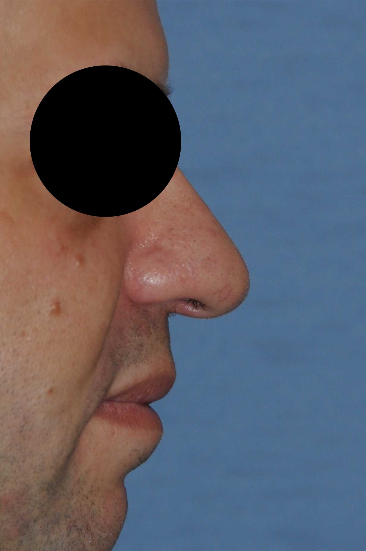 Rhinoplasty Before & After Photo