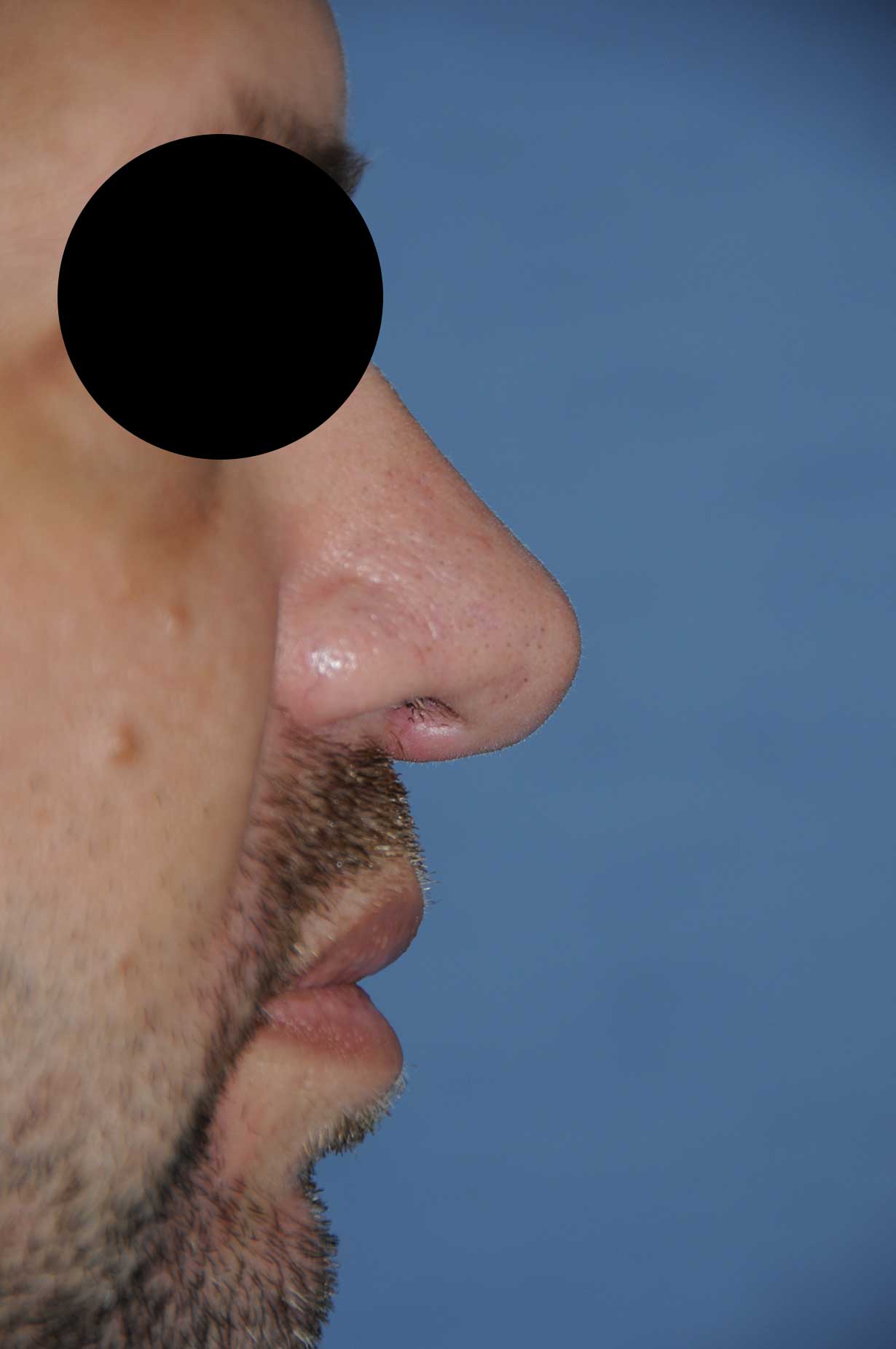 Rhinoplasty Before & After Photo